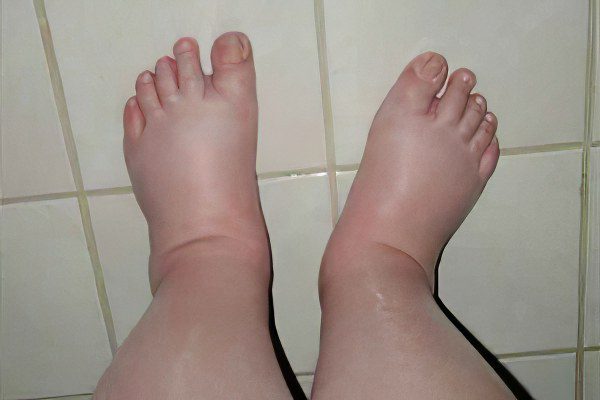 Edema during pregnancy, what to do?