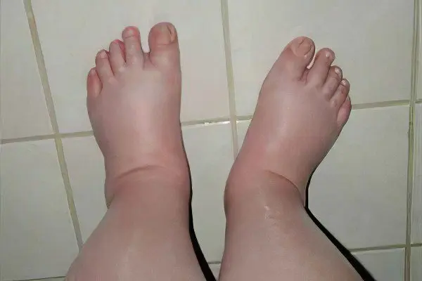 Edema during pregnancy, what to do?