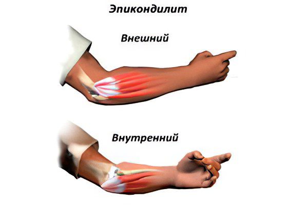 Elbow epicondylitis (elbow joint)