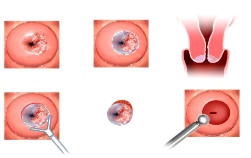 Electroconization of the cervix with dysplasia