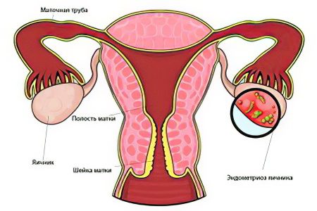 Endometriosis of the ovary