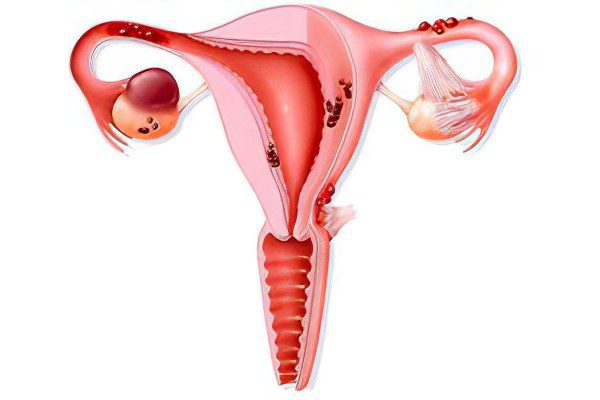 Endometriosis of the ovary