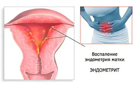 Endometritis: symptoms and treatment