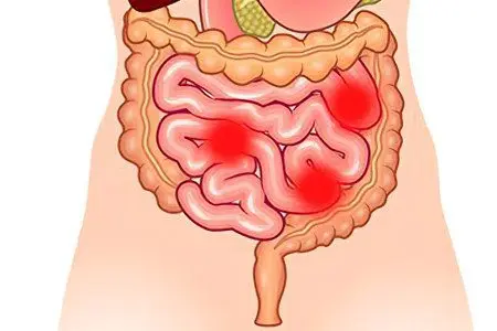 Enteritis: causes, symptoms and treatment