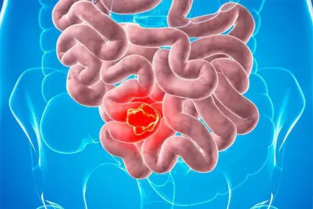 Enteritis: causes, symptoms and treatment