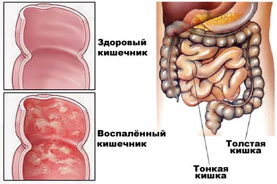 Энтероколит