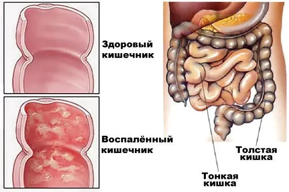 Enterocolitis