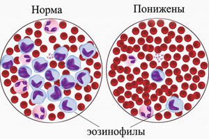 Eosinophilia: what is it and how to treat it?