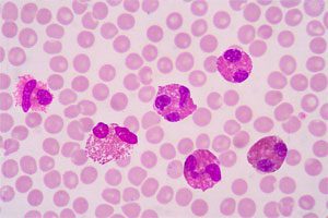 Eosinophilia: what is it and how to treat it?