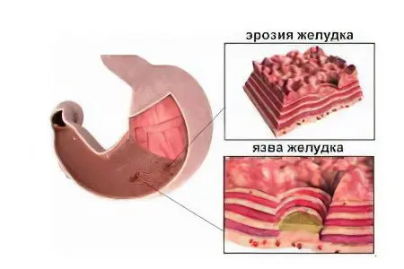 Erosive gastritis