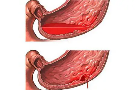 Erosive gastroduodenitis