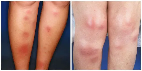 Erythema: causes, symptoms and treatment