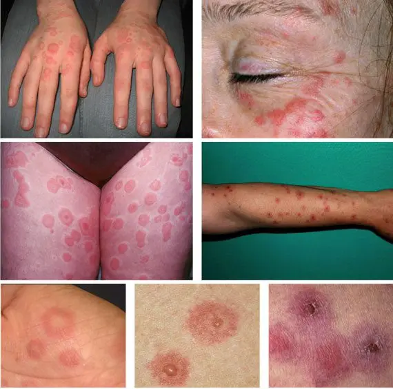 Erythema: causes, symptoms and treatment