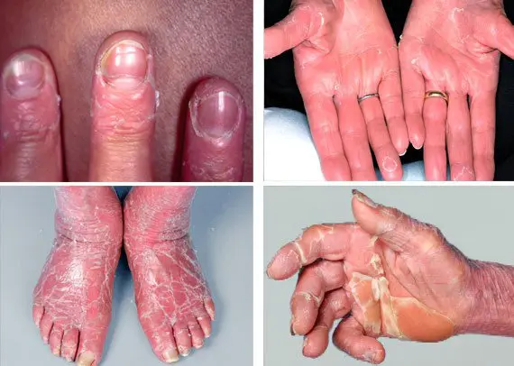 Erythema: causes, symptoms and treatment