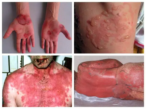 Erythema: causes, symptoms and treatment