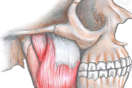 Facial muscle atrophy