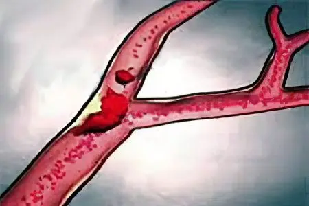 Fat, air, pulmonary and gas embolism