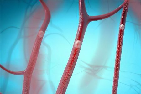 Fat, air, pulmonary and gas embolism