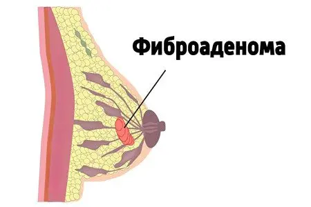 Fibroadenoma of the breast: symptoms and treatment