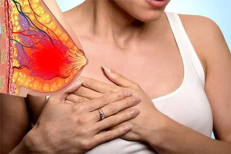 Fibroadenoma of the breast: symptoms and treatment