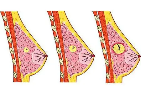 Fibroadenoma of the breast: symptoms and treatment