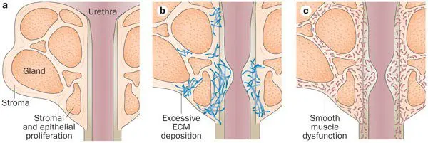 Fibrosis of the prostate