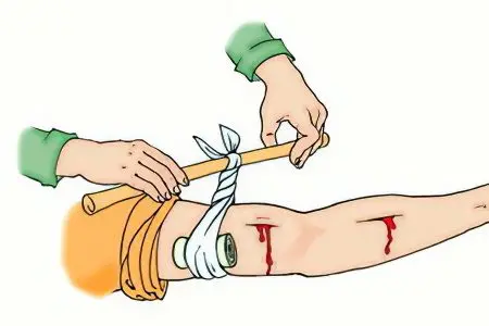 First aid for arterial bleeding