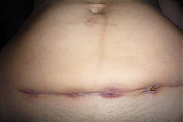 Fistula at the seam after caesarean section