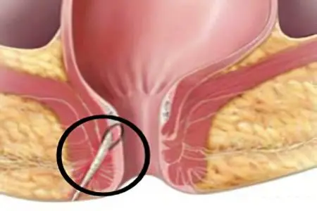 Fistula of the rectum