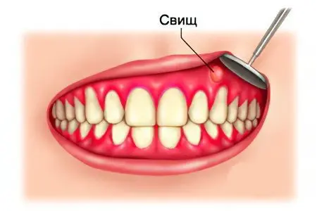 Fistula on the right tooth