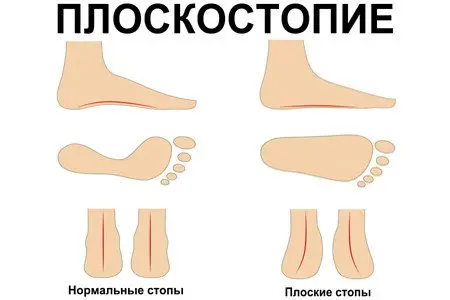 Flat feet: types, stages, symptoms and treatment