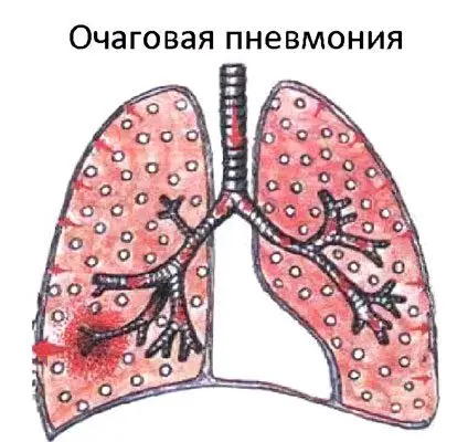 Focal pneumonia: causes, symptoms and treatment