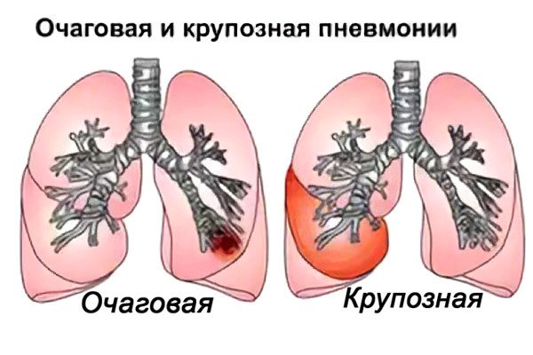 Focal pneumonia: causes, symptoms and treatment