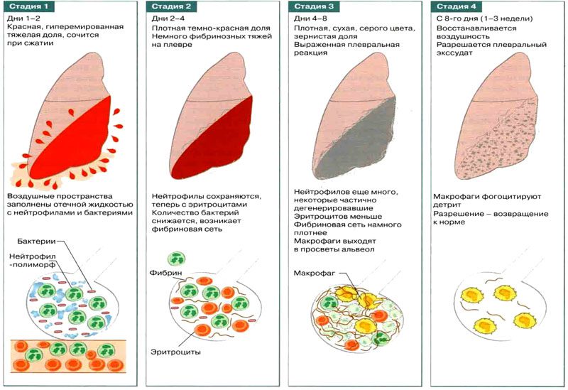 Focal pneumonia: causes, symptoms and treatment