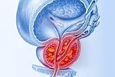 Forms and types of prostatitis