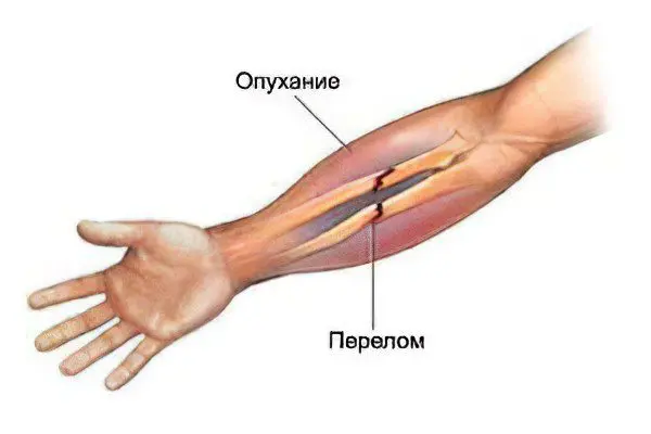 Fracture of the arm bone