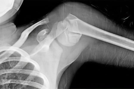 Fracture of the humerus with and without displacement