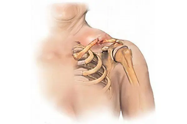 Fracture of the humerus with and without displacement