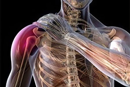 Fracture of the humerus with and without displacement