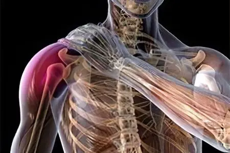 Fracture of the humerus with and without displacement