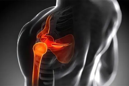 Fracture of the humerus with and without displacement