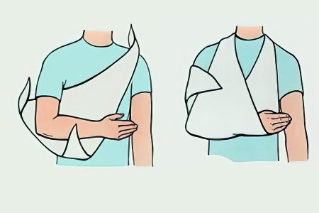 Fracture of the humerus with and without displacement