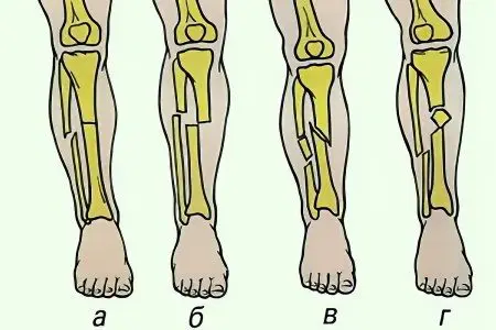 Fracture of the leg bones