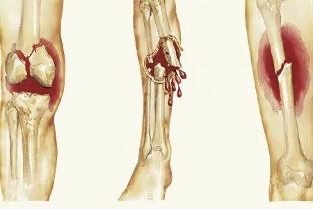 Fracture of the leg bones