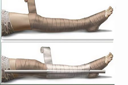 Fracture of the leg bones