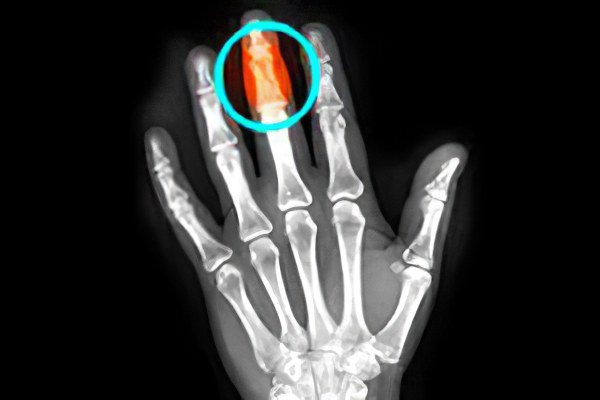 Fracture of the phalanx of the finger