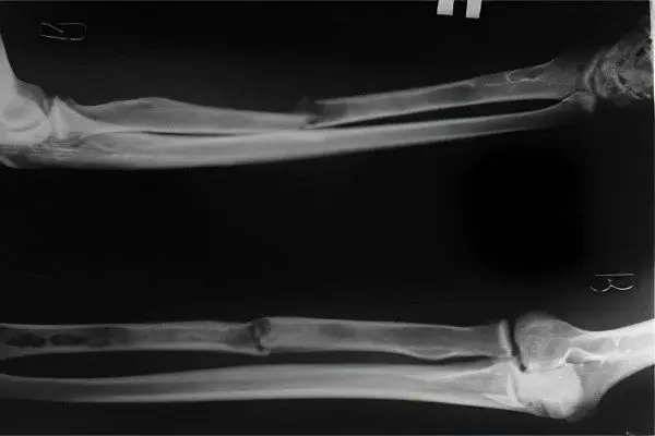 Fracture of the radius with and without displacement &#8211; rehabilitation and treatment