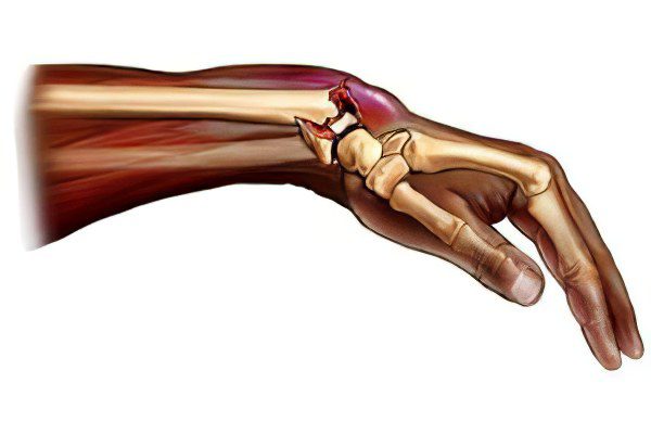 Fracture of the radius with and without displacement - rehabilitation and treatment