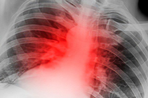 Fracture of the sternum (chest)