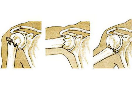 Fracture of the surgical neck of the shoulder (humerus)